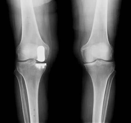 After Surgery