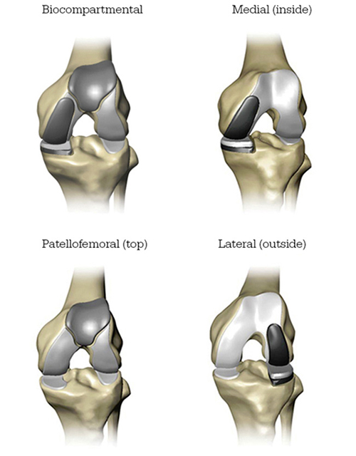 Infographic - How Mako Technology works - •	Mako Robotic-Arm Assisted partial knee replacement1