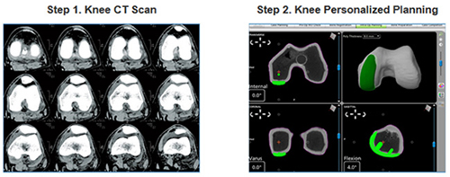 Infographic - How Mako Technology works - •	Mako Robotic-Arm Assisted partial knee replacement2