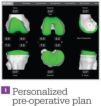 Infographic - Mako Technology - Personalized Pre-Operative Plan