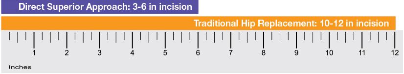 Ruler incisions