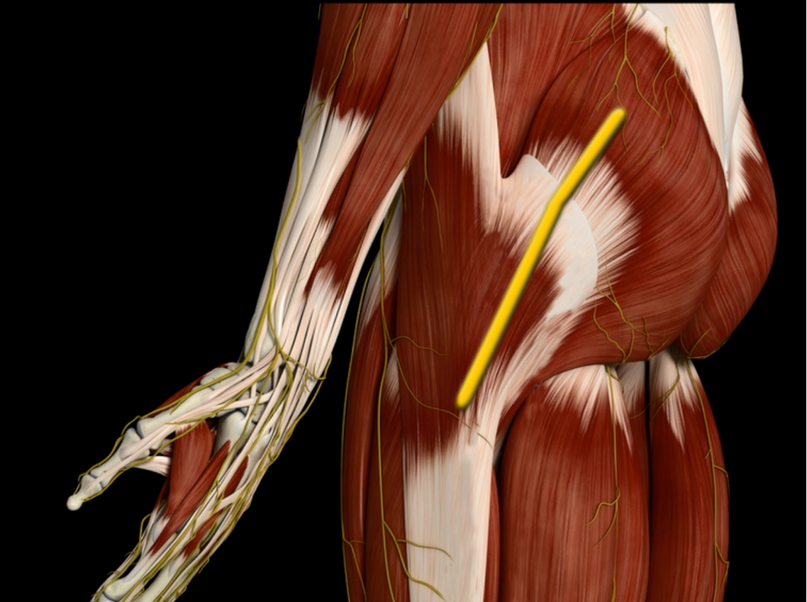 Traditional Hip Replacement1